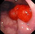 PEDUNCULATED POLYP