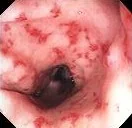 POST IRRADIATION COLITIS