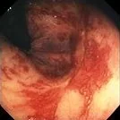 POST IRRADIATION COLITIS