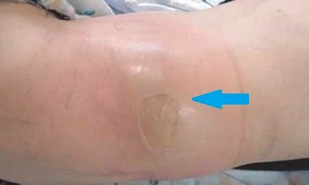 PSOAS ABSCESS