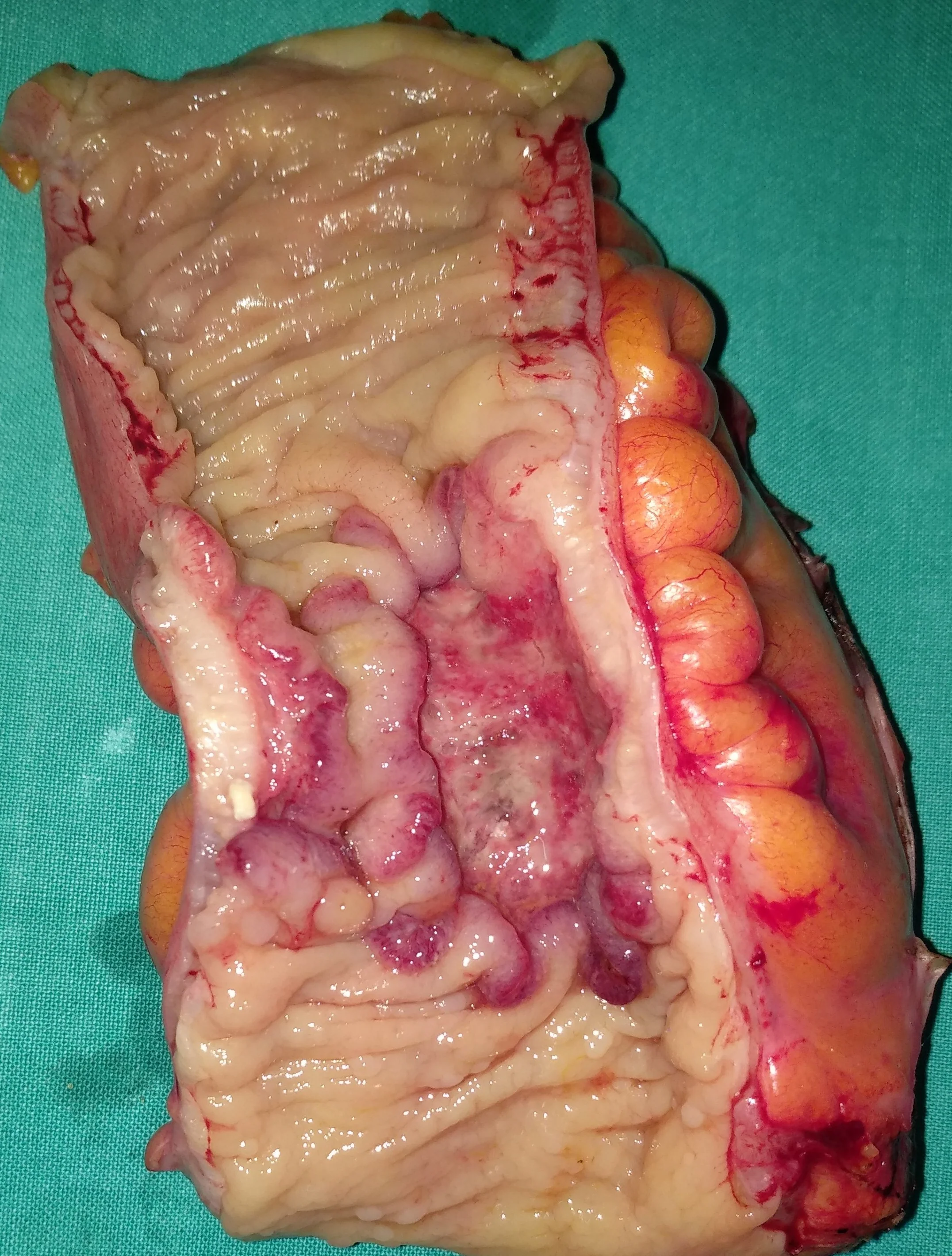 RECTAL CARCINOMA