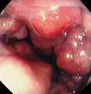 RECTAL HEMANGIOMA