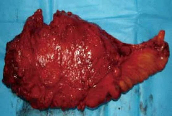 RECTAL HEMOLYMPHANGIOMA