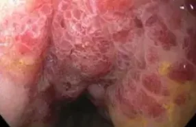 RECTAL KAPOSI SARCOMA