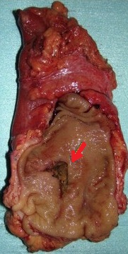 RECTAL WALL EROSION BY RECTOPEXY MESH 
