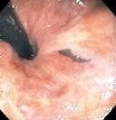 RECTAL NEVUS