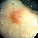 RECTAL SPIDER ANGIOMA