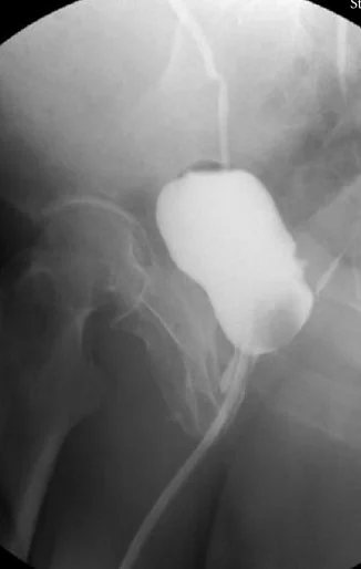 RECTOURINARY FISTULA