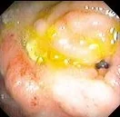 RECTOVAGINAL FISTULA