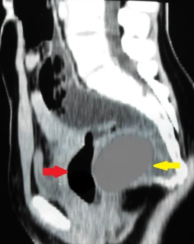 RETRORECTAL EPIDERMOID CYST