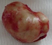 RETRORECTAL EPIDERMOID CYST