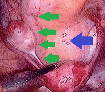 RETRORECTAL TUMOR
