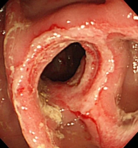 RHEUMATOID ARTHRITIS - RECTAL ULCER