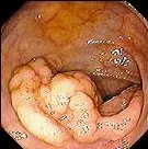 SESSILE VILLOUS ADENOMA