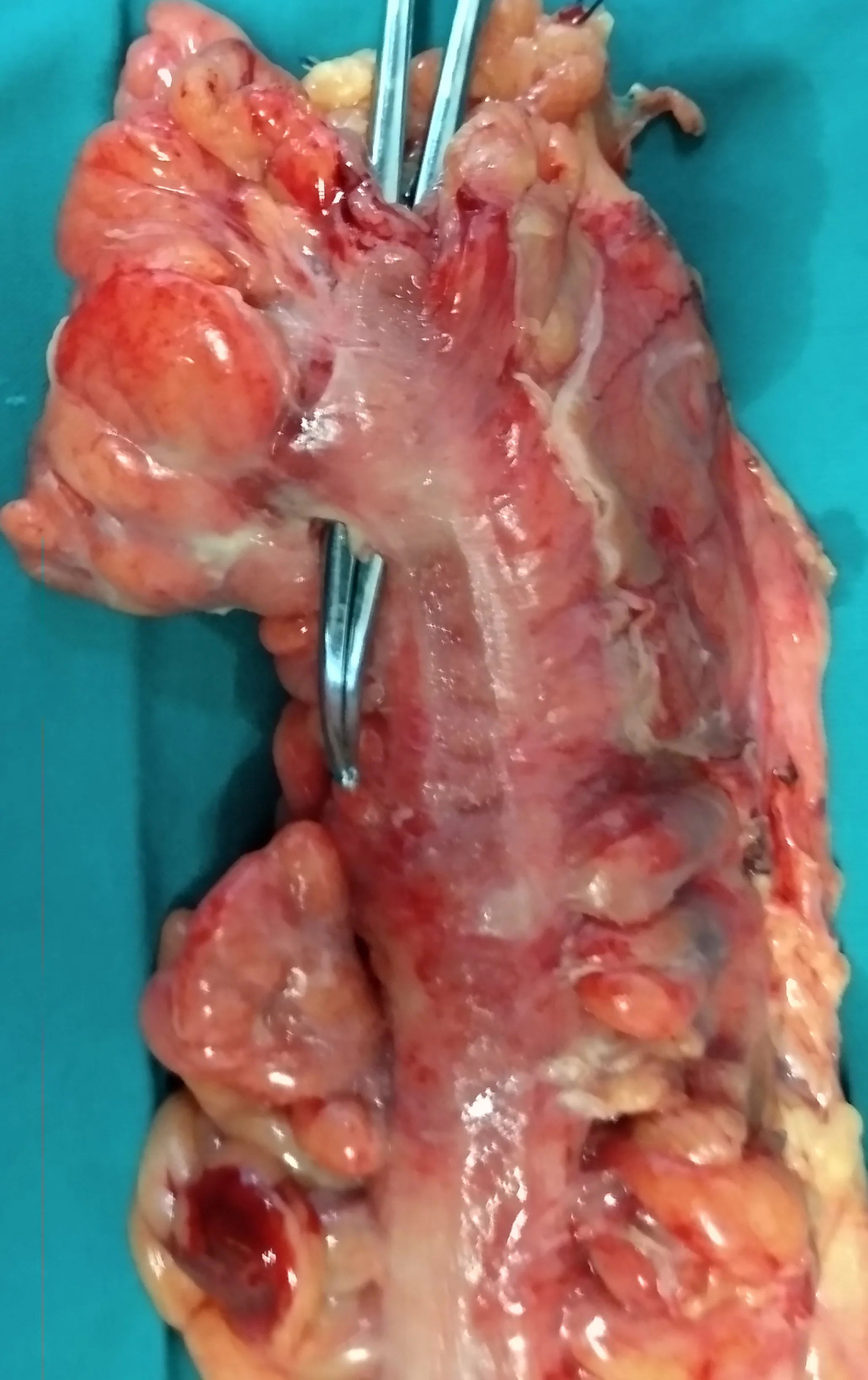 SIGMOID PLASTRON