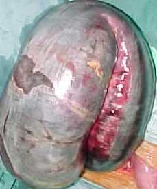 SIGMOID VOLVULUS