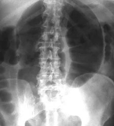 SIGMOID VOLVULUS
