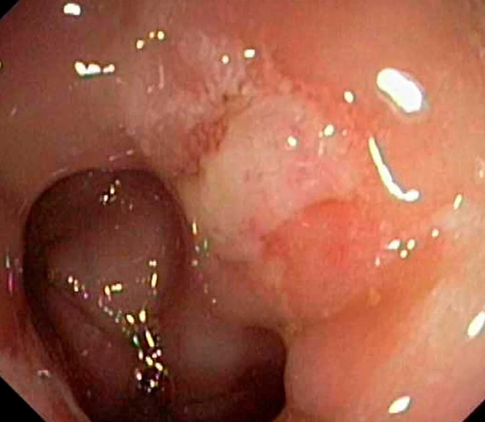 SOLITARY RECTAL ULCER