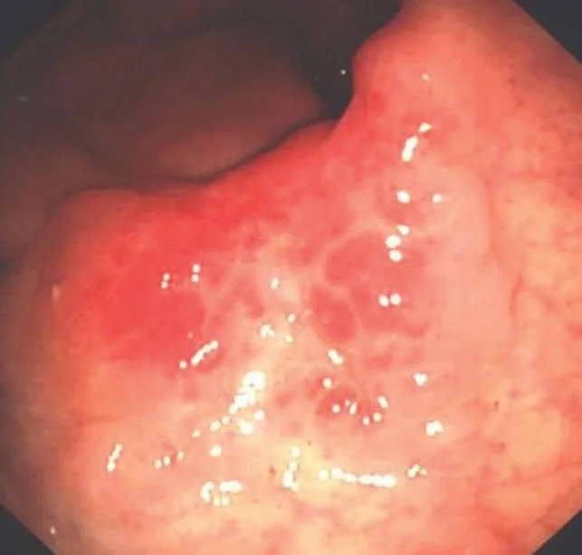 SOLITARY RECTAL ULCER