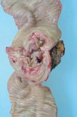 SPONTANEOUS DESCENDING COLON CARCINOMA RUPTURE