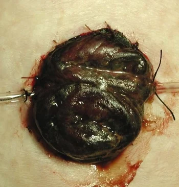 STOMA NECROSIS