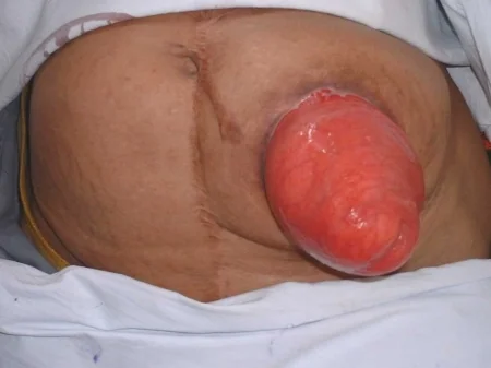 STOMA PROLAPSE