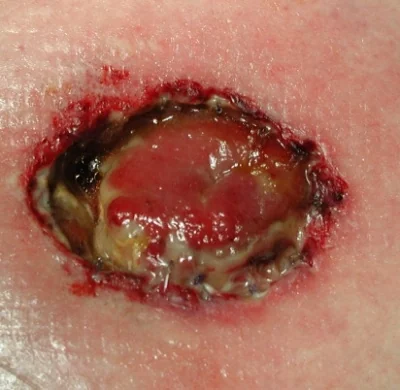 STOMA RETRACTED