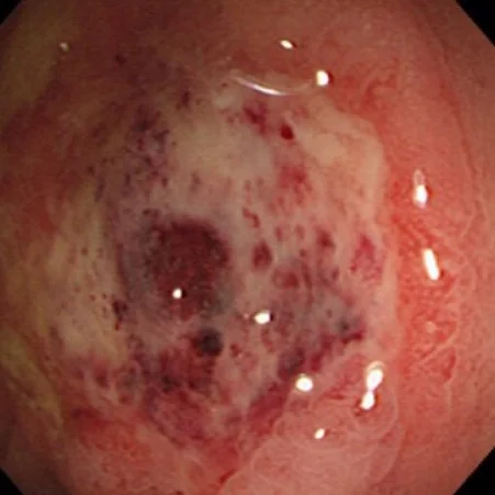 SYSTEMIC LUPUS ERYTHEMATOSUS - COLONIC ULCER