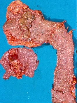 SYNCHRONOUS CARCINOMAS OF SMALL AND LARGE BOWEL