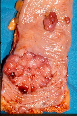 SYNCHRONOUS DESCENDING COLON ADENOCARCINOMAS