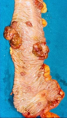SYNCHRONOUS COLONIC CARCINOMAS