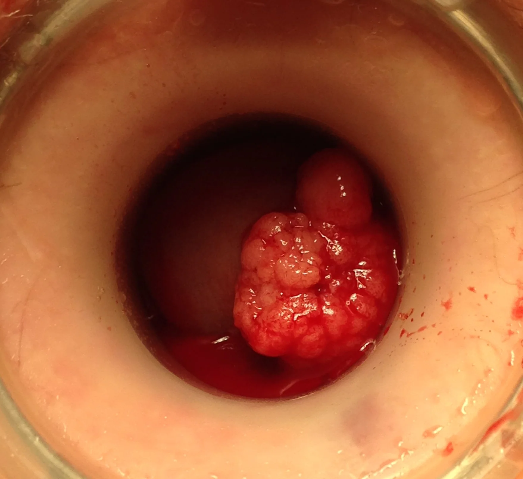 RECTAL POLYP - TAMIS