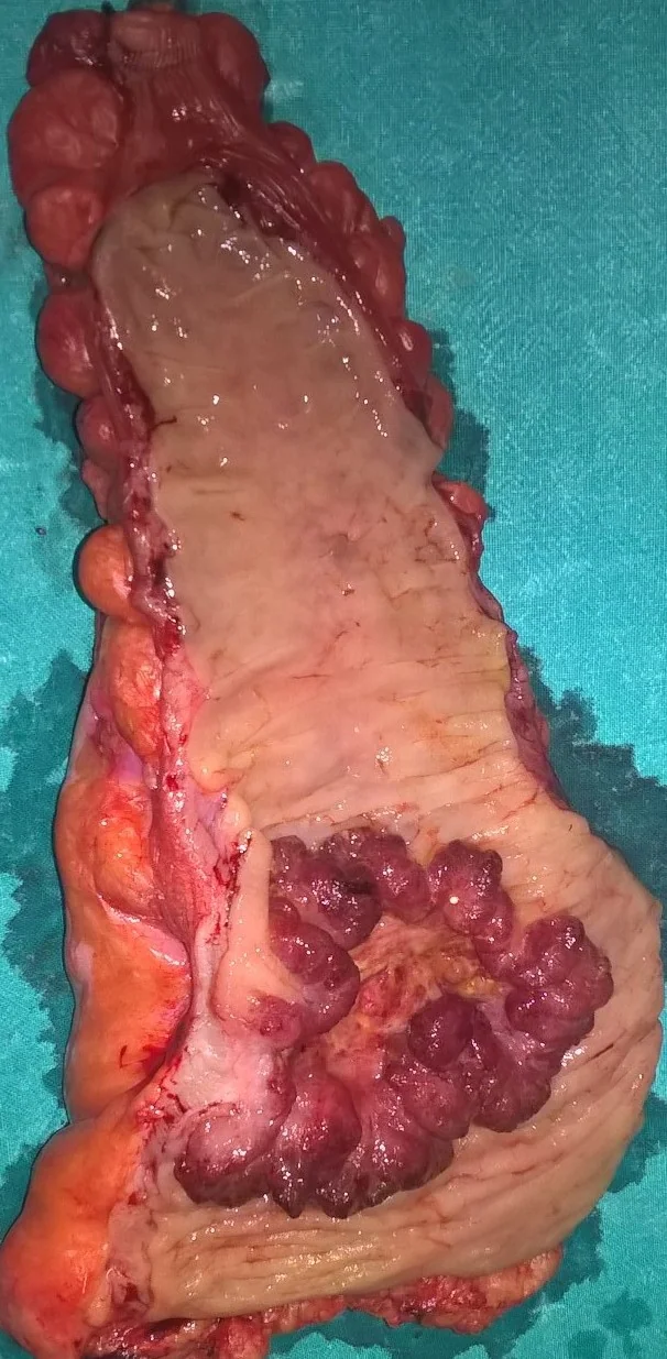 RECTAL CARCINOMA