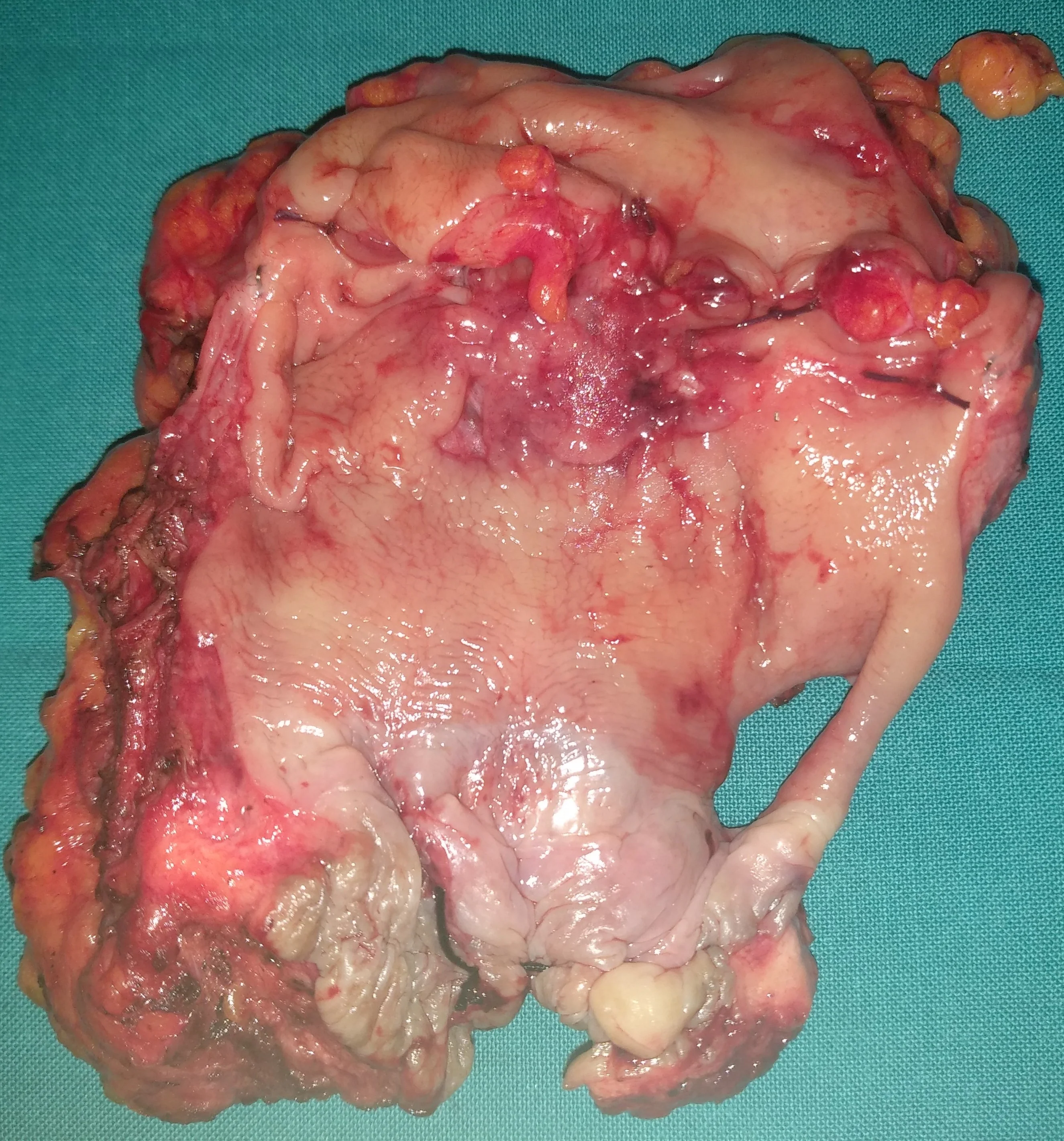 RECURRENCE RECTAL CARCINOMA