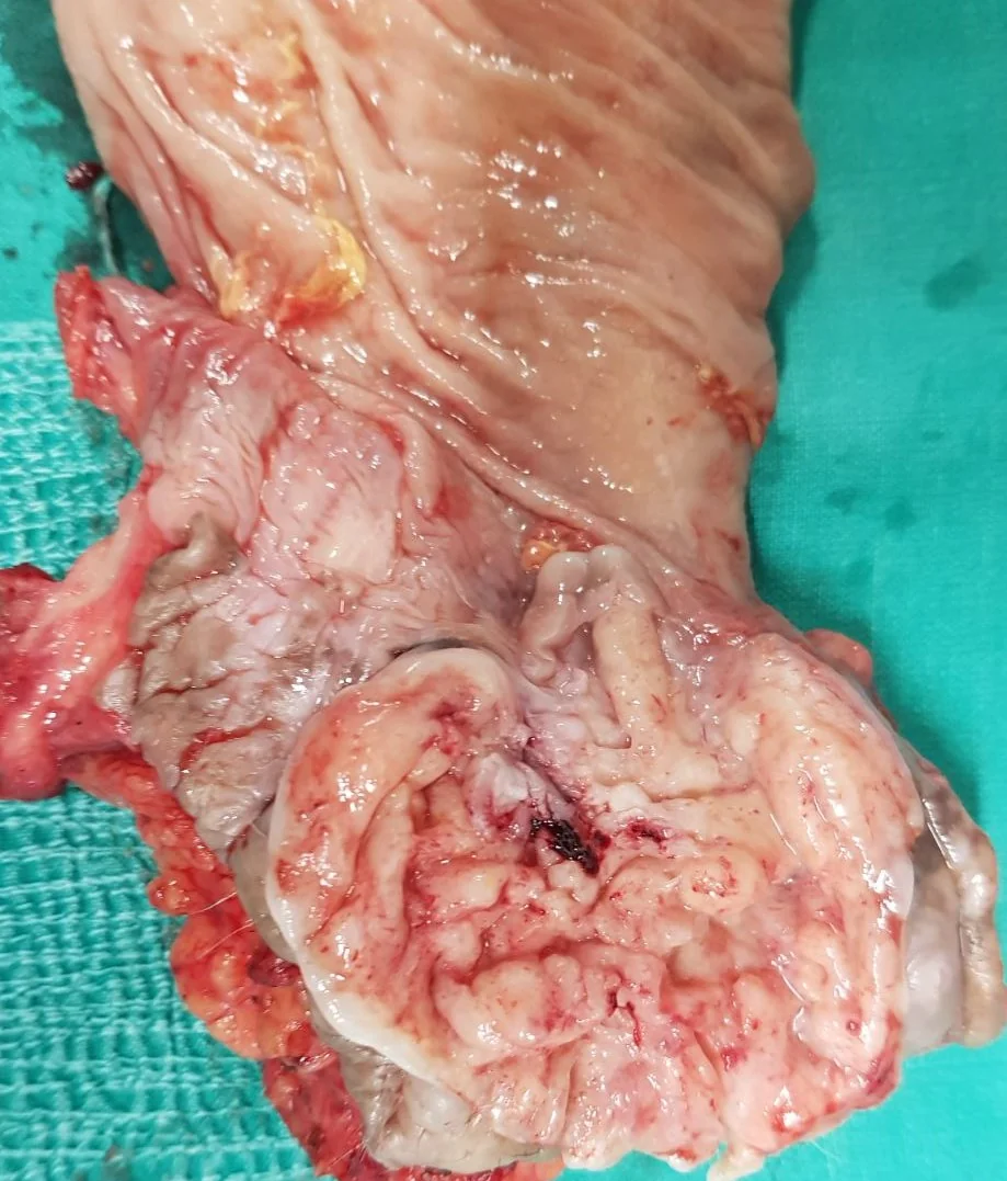 ANAL CARCINOMA