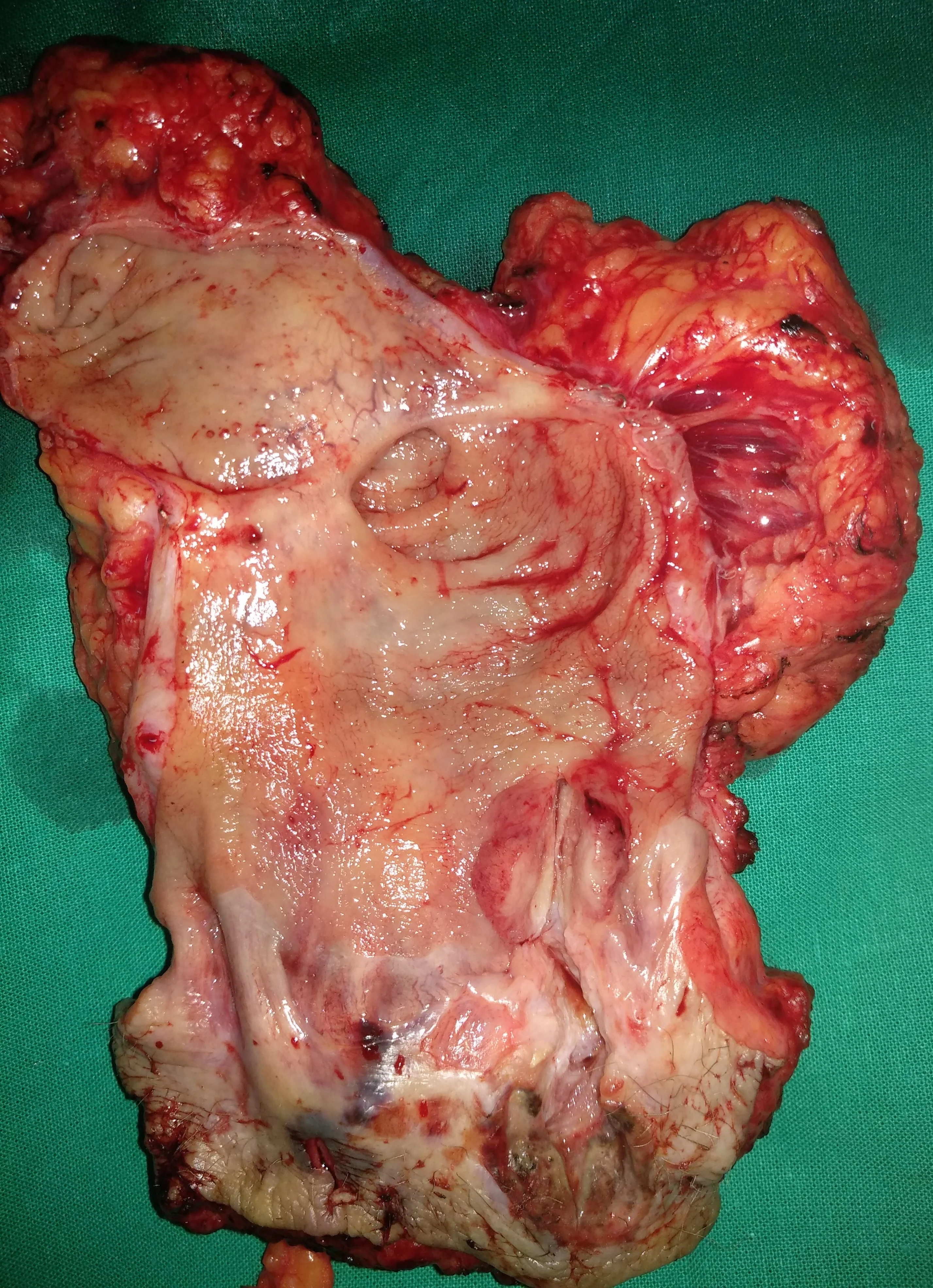 ANAL CARCINOMA
