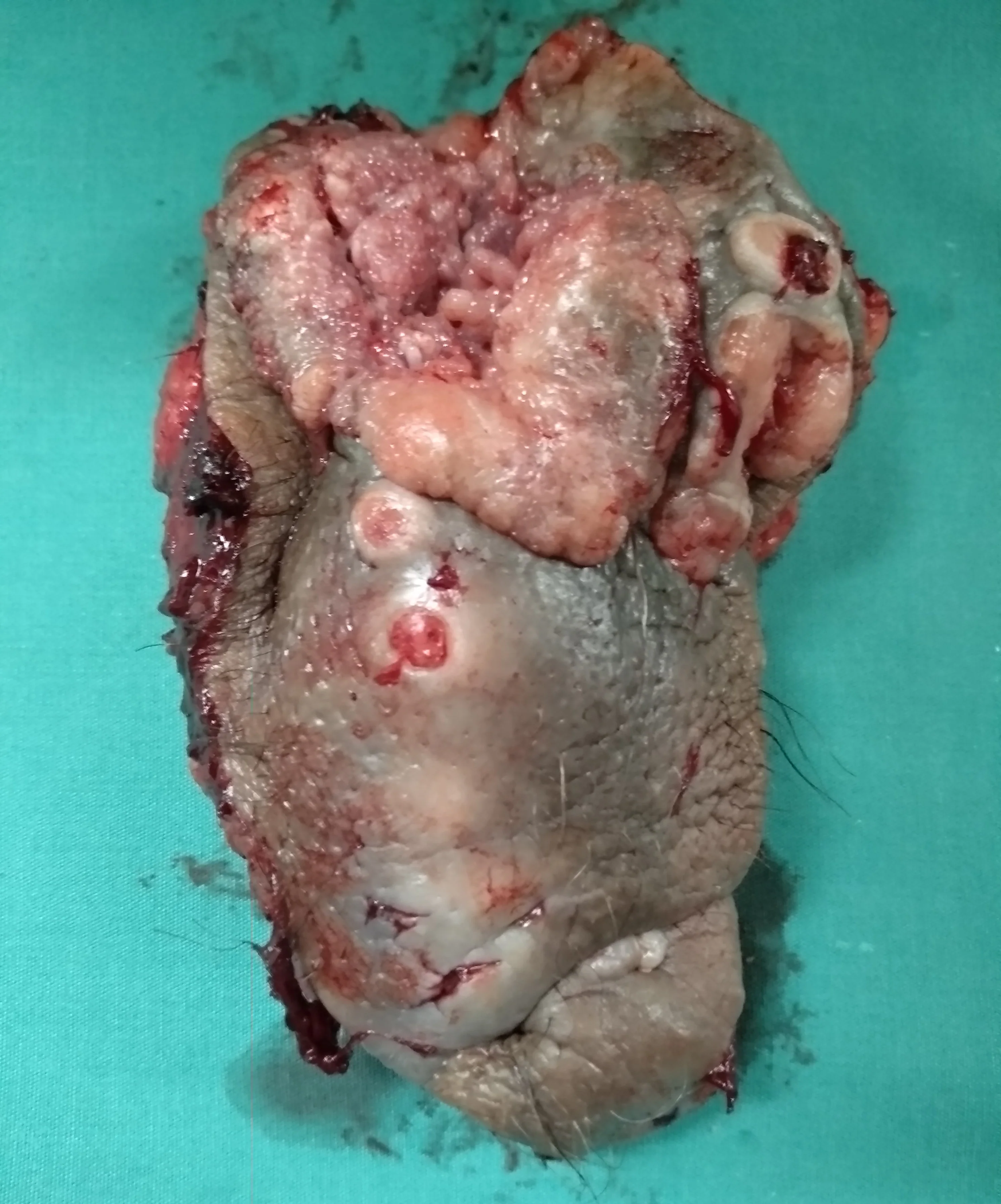 SQUAMOUS CARCINOMA AND ANAL WARTS