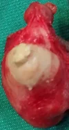 EXCISION PERINEAL EPIDERMOID CYST