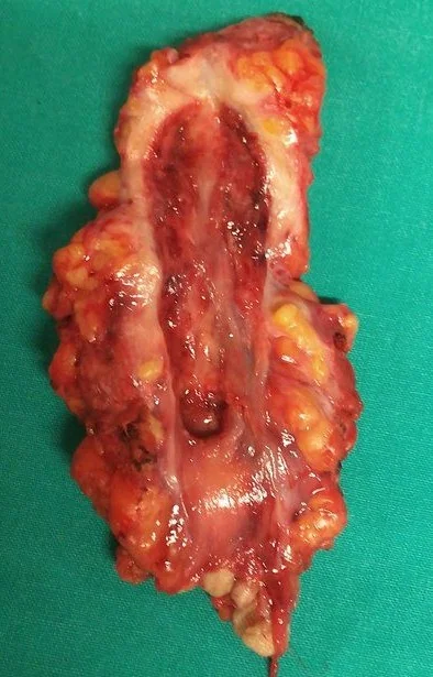 PARARECTAL FISTULA