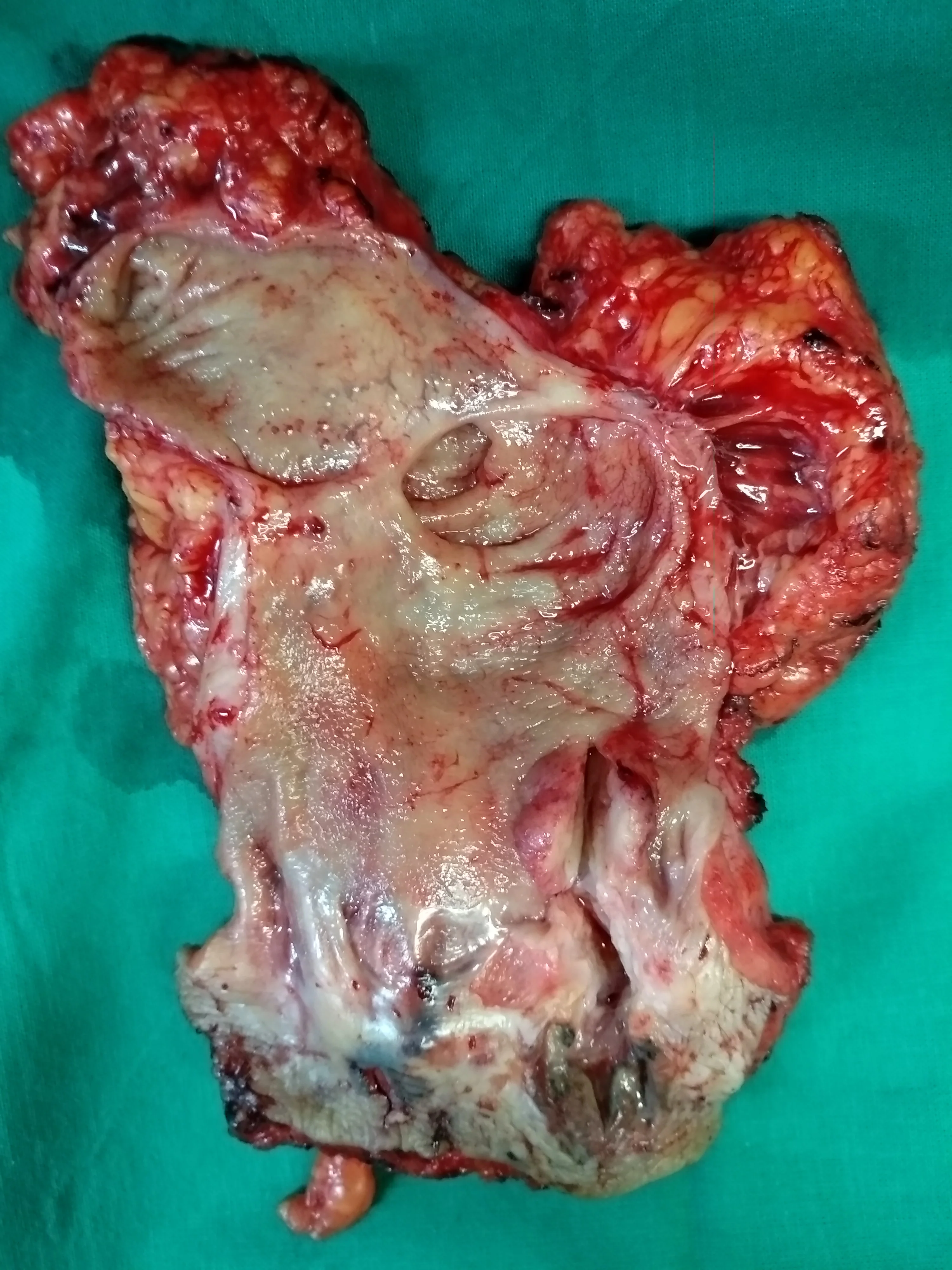 SQUAMOUS ANAL CARCINOMA