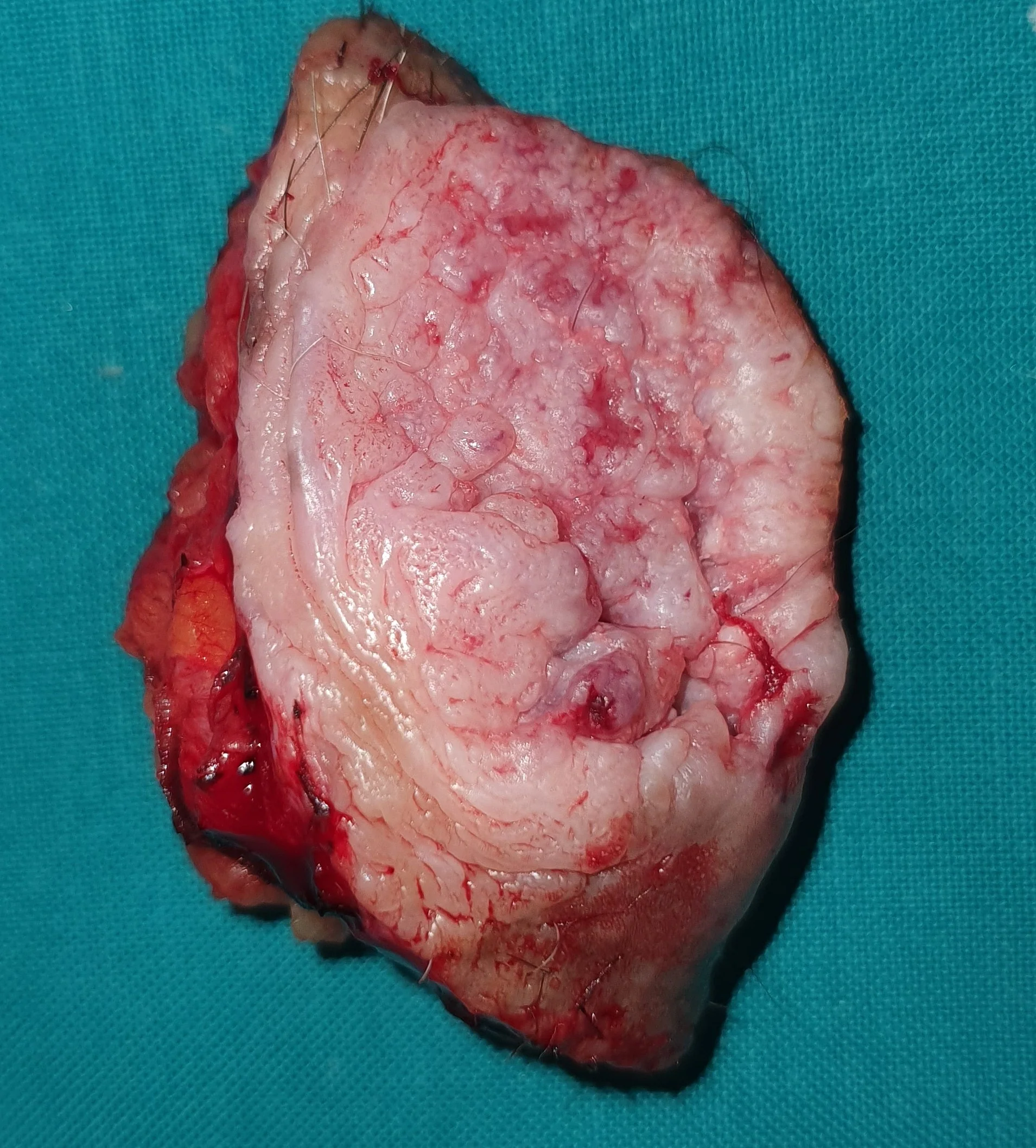 PARA-ANAL SQUAMOUS CELL CARCINOMA