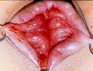HAEMORRHOIDS