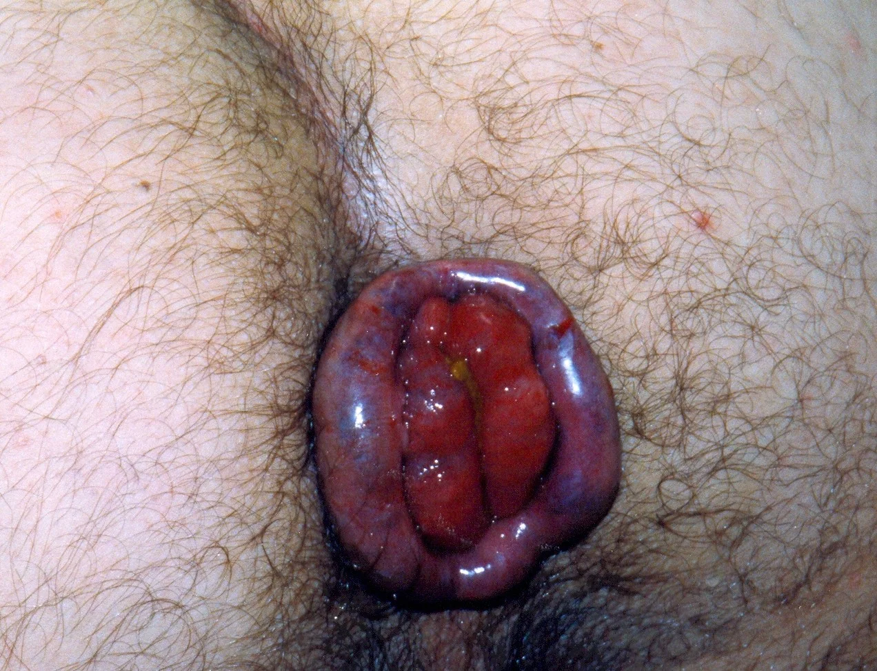 HAEMORRHOIDS