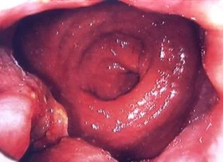 ANAL CARCINOMA