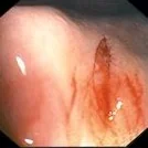 ANAL FISSURE