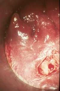 ANAL FISSURE