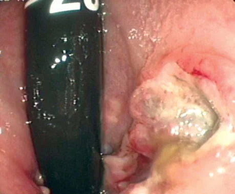 ANAL HISTIOCYTOMA