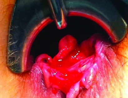 ANAL MYELOID SARCOMA
