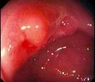 ANAL SQUAMOUS CELL CARCINOMA
