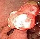 CLOACOGENIC POLYP